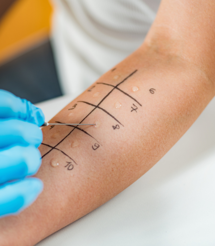 Allergy Prick or Intradermal Skin Testing